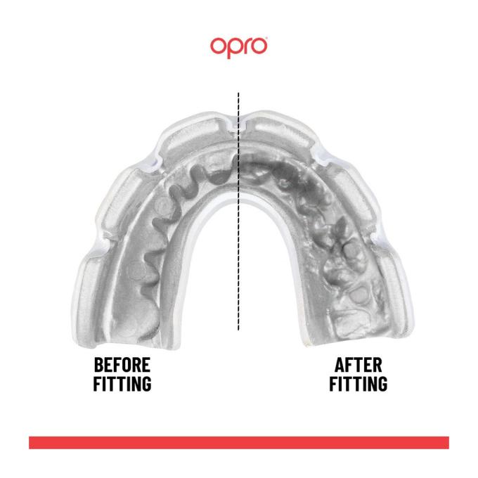 Opro Instant_Braces_Clear